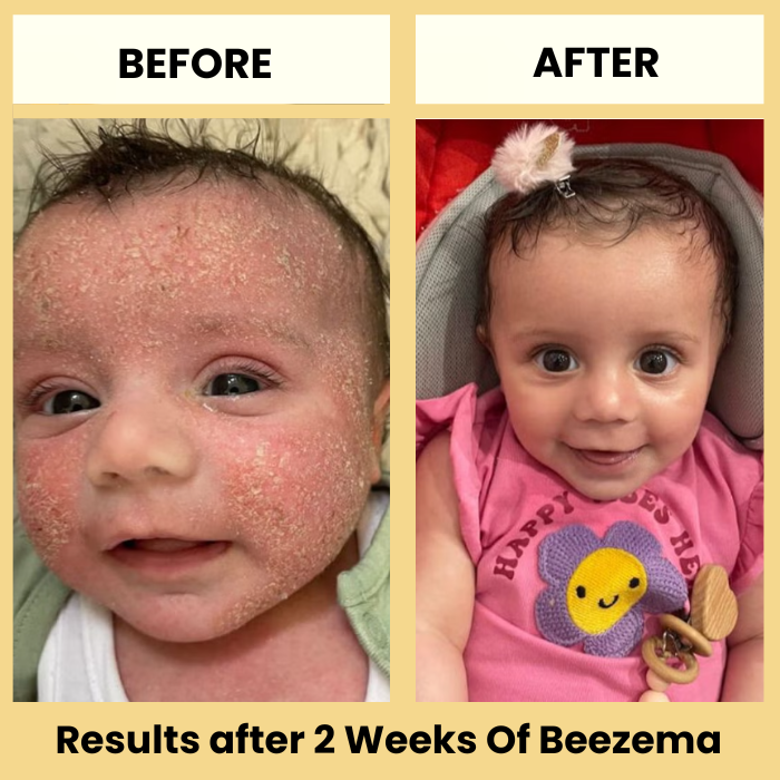 Finally Stop Your Baby's Endless Scratching Naturally with Beezema