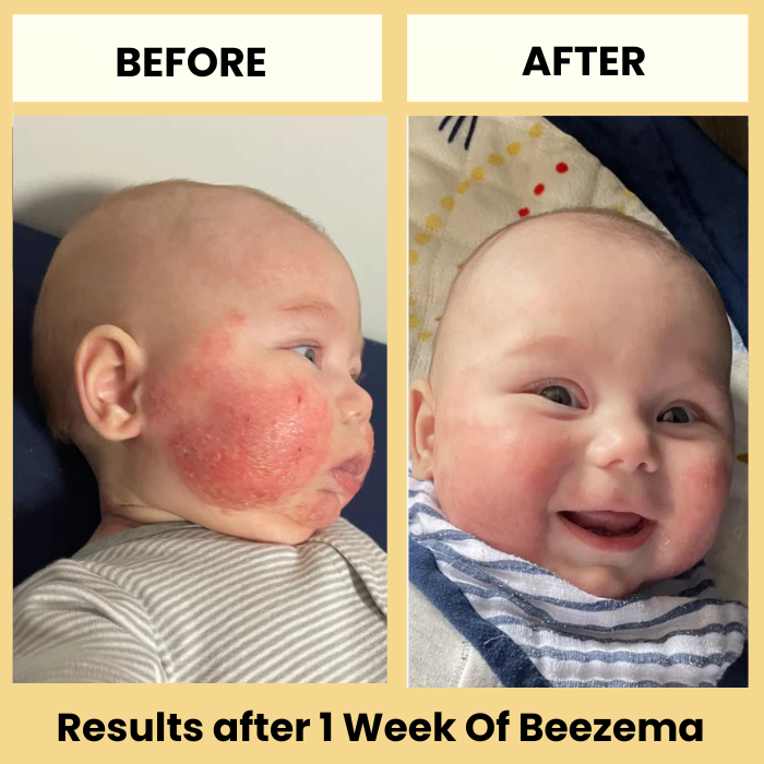 Finally Stop Your Baby's Endless Scratching Naturally with Beezema