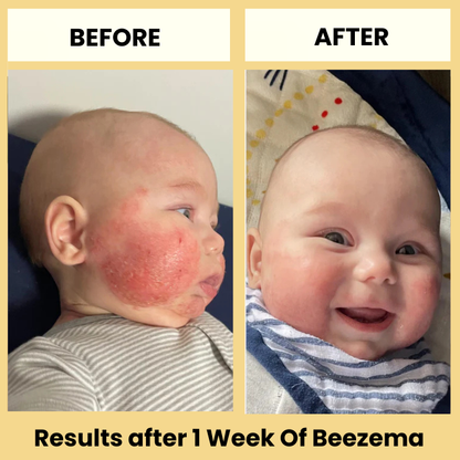 Finally Stop Your Baby's Endless Scratching Naturally with Beezema