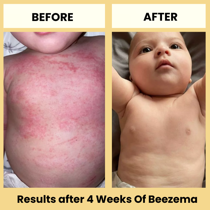 Finally Stop Your Baby's Endless Scratching Naturally with Beezema
